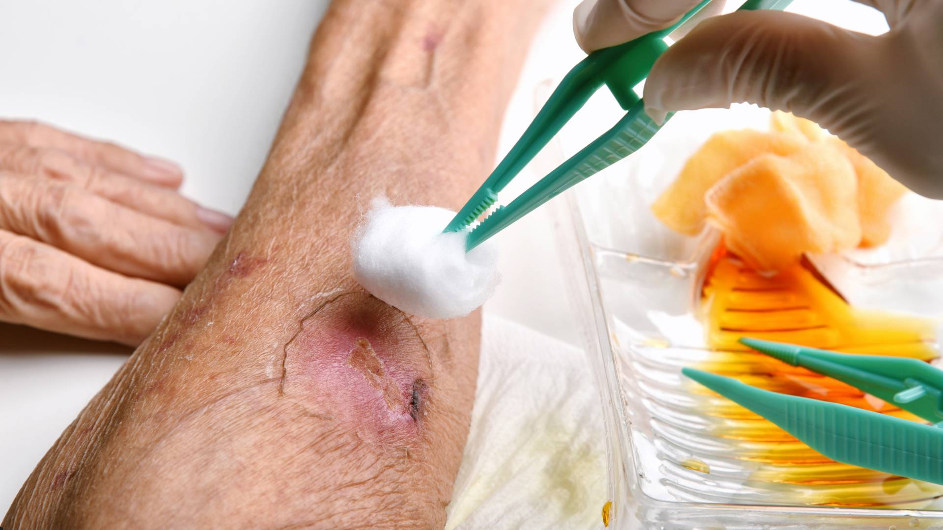 Sağalmayan yaraların evdə müalicəsi