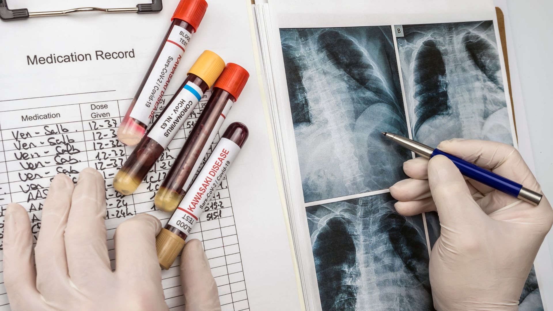 Kavasaki xəstəliyinin diaqnozu