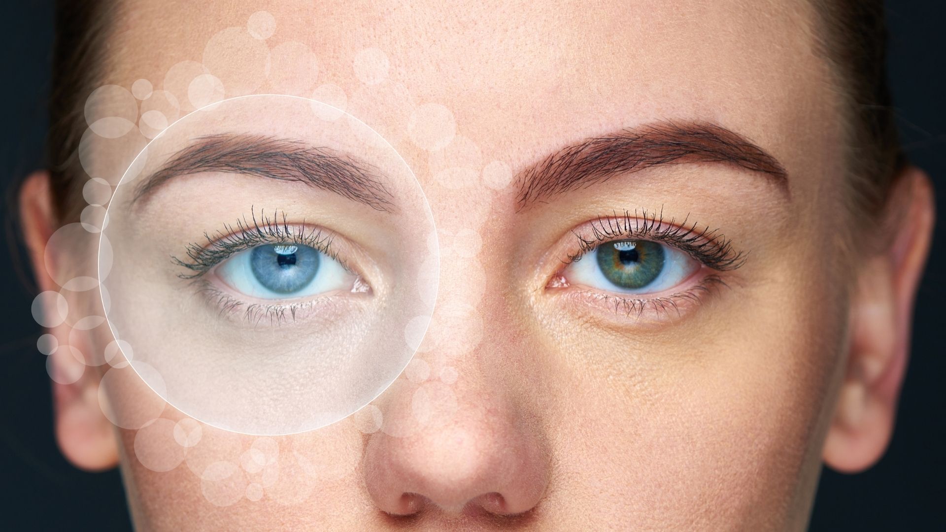 Keratopiqmentasiya nə dərəcədə uğurludur