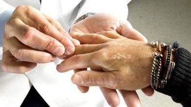 Sklerodermiya xəstəliyi əlamətləri və müalicəsi - saglamyasha.az