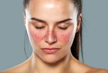 Sistem qırmızı qurdeşənəyi (SQQ) və ya Sistem Lupus eritematosus (SLE) xəstəliyinin yaranma səbəbləri, simptonları və müalicəsi