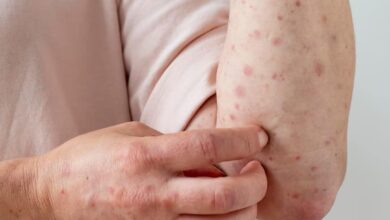 Göbələk xəstəliyi. Əlamətləri və müalicəsi | 2023