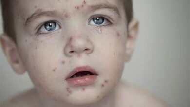 Qızılca xəstəliyi. Əlamətləri və müalicəsi | 2023