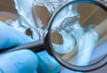 koksertoz nedir koksertoz mualicesi