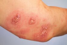 Pemfiqus xəstəliyi