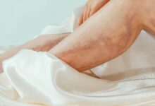 Villebrand xəstəliyi