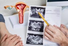  Polikistik over sindromu