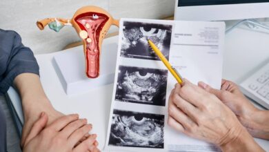  Polikistik over sindromu