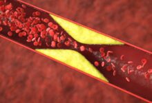 tromb (qan laxtalanması)